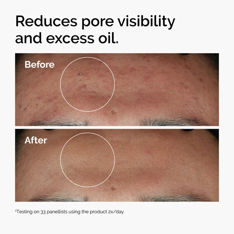 The Ordinary Niacinamide 10% + Zinc 1% Serum 30ml | Original Face Serum